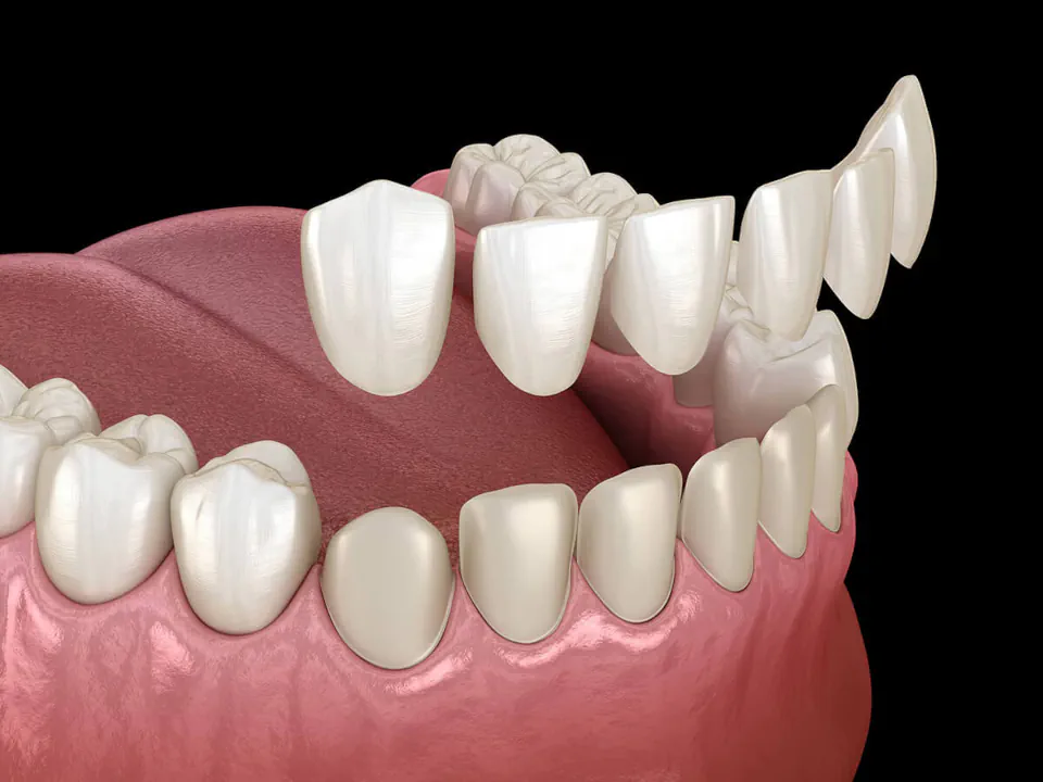 Cosmetic dentistry and veneers in Missouri City, TX