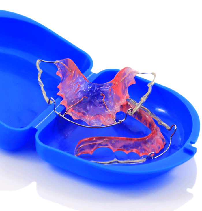The image shows a dental retainer placed inside a blue plastic case. The retainer is pink with metal wires and is designed to fit both the upper and lower teeth. It's an orthodontic device used to maintain teeth alignment after braces are removed.
