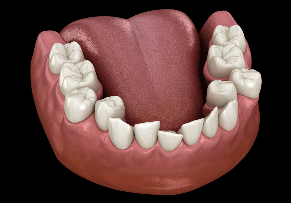 3D illustration of a lower jaw model showing crowded teeth with uneven alignment, detailed tooth structure and pink gums, set against a dark background, highlighting orthodontic treatment needs.