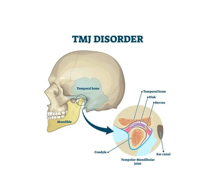 tmj disorder illustration