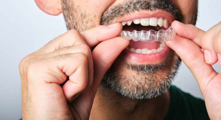 Invisalign and clear aligner treatment for teeth spacing