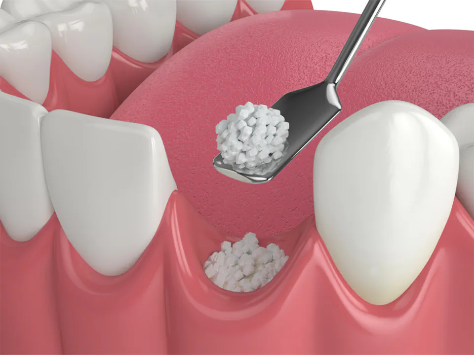 Dental bone grafting available at Missouri City Dentistry in Missouri City, TX