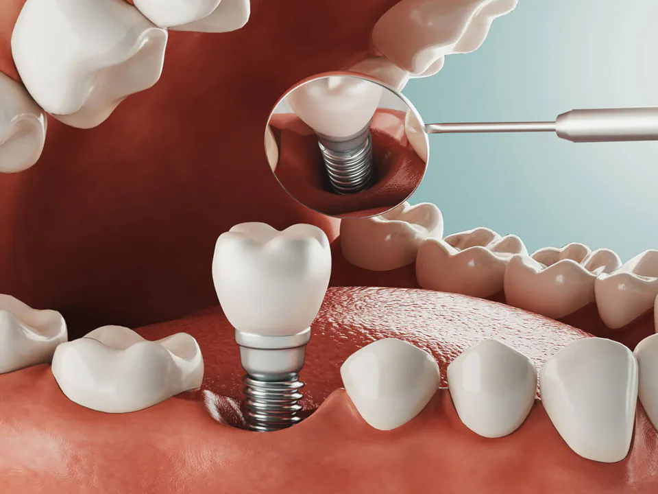 Dental implants at Missouri City Dentistry in Missouri City, TX