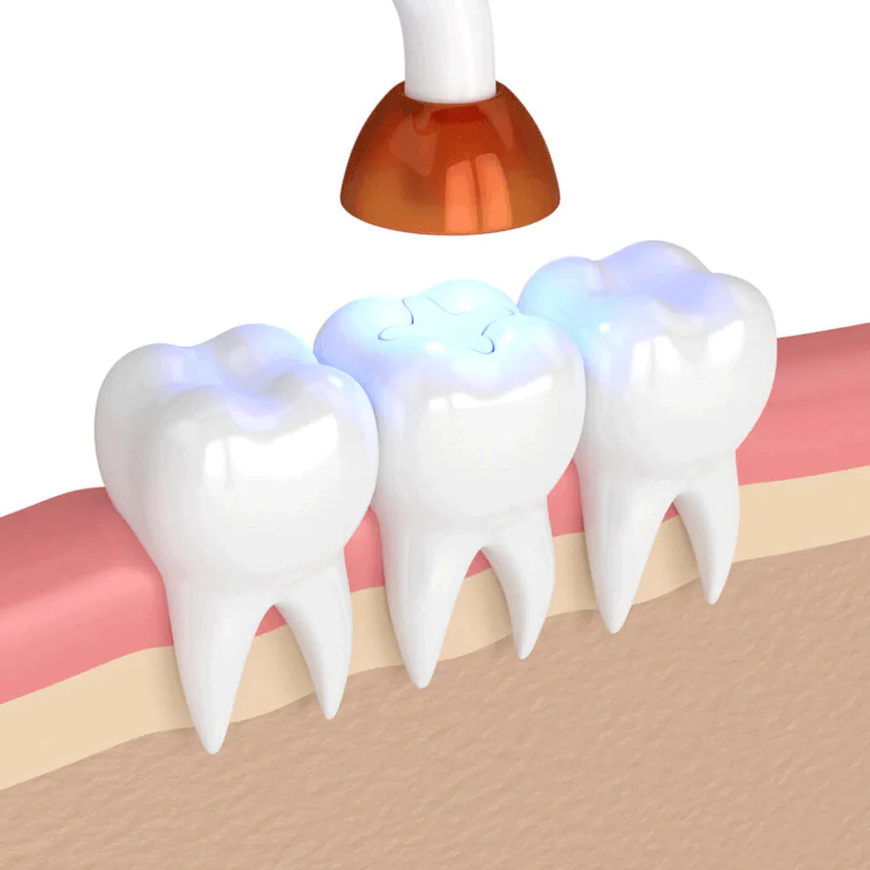 Tooth fillings and dental sealants at Missouri City Dentistry in Missouri City, TX