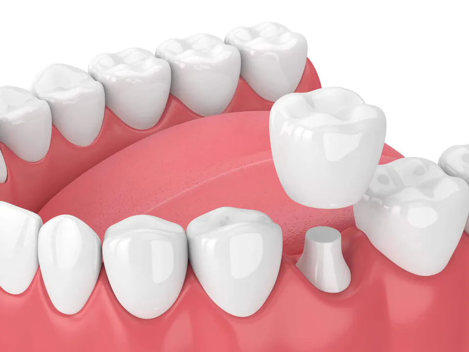 Dental crowns and dental bridges at Missouri City Dentistry in Missouri City, TX