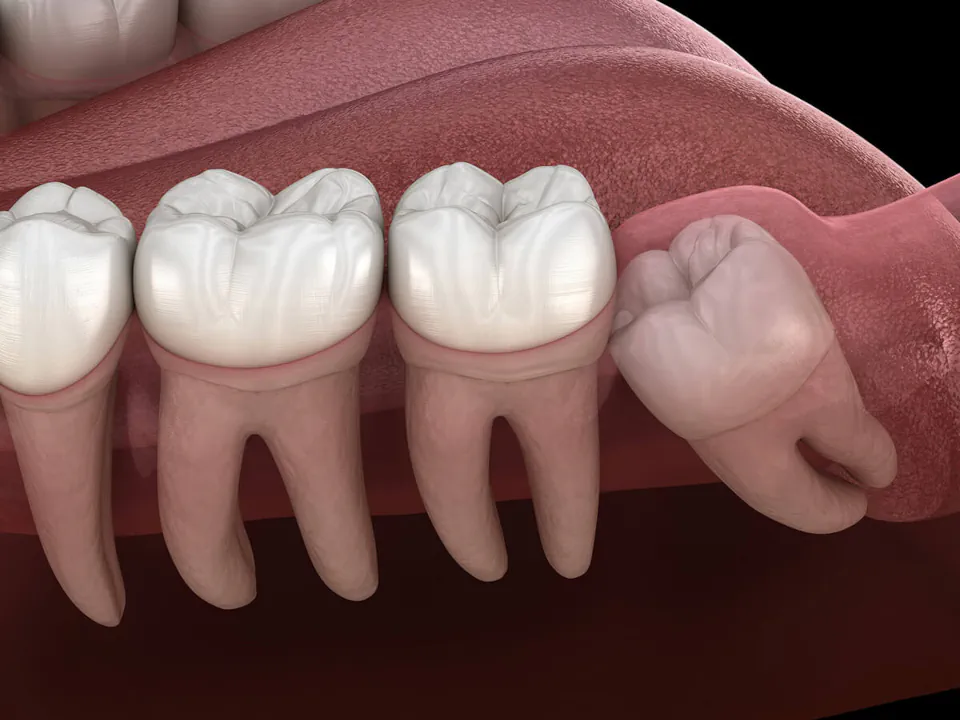 Wisdom teeth removal at Missouri City Dentistry in Missouri City, TX